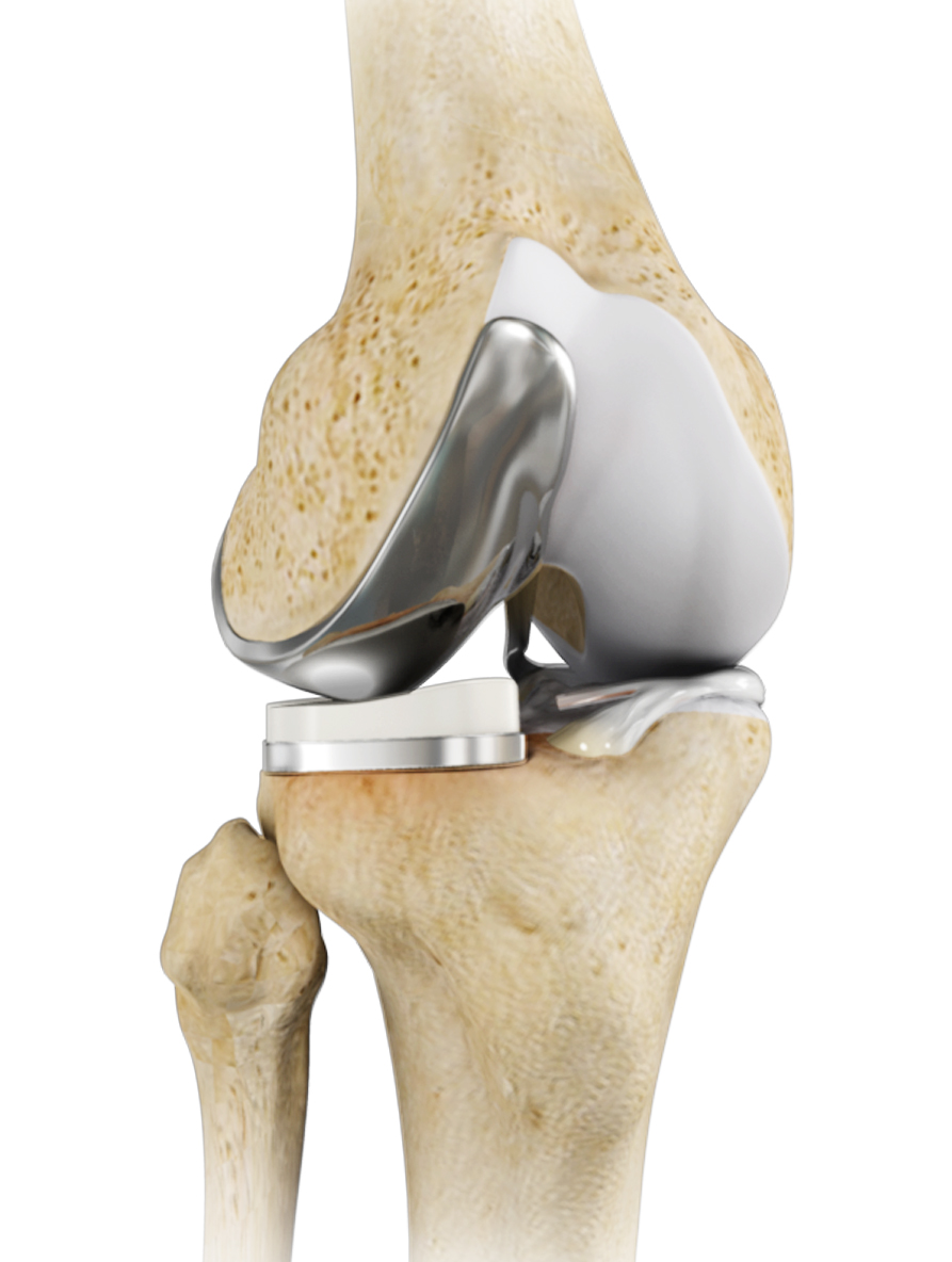 Unicompartmental Knee Replacement