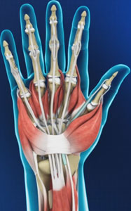 Hand Pain Treatment Atlanta, GA | Wrist Fractures Stockbridge