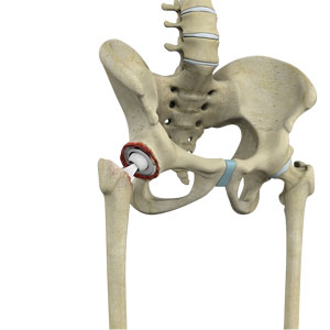 Joint Revision Replacement Surgery