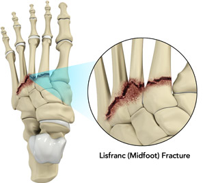 Lisfranc Midfoot Fracture